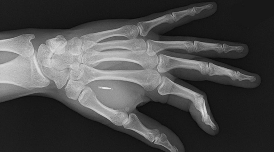 Man implants microchip in his hands to open doors & unlock car with ease